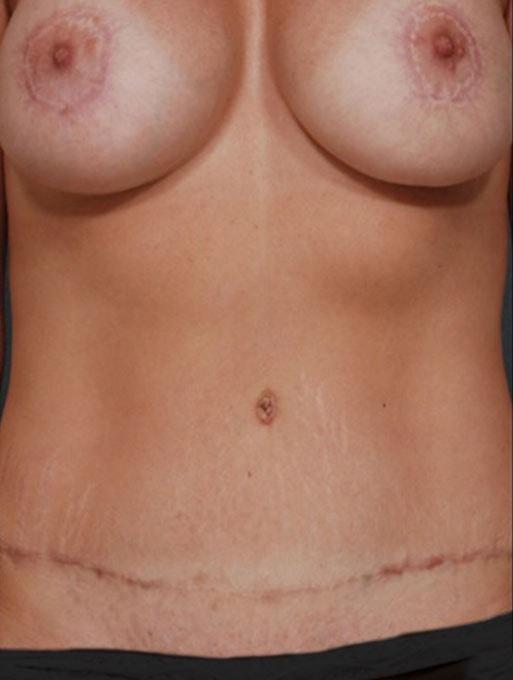 Mommy Makeover after at Bucky Plastic Surgery (Louis P. Bucky, MD) in Philadelphia, PA