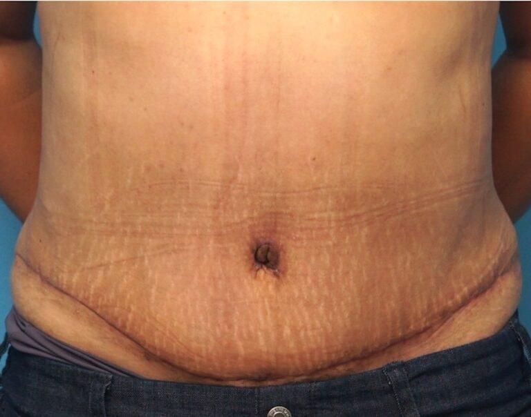 Seth Plastic Surgery tummy tuck after — Northbrook, IL