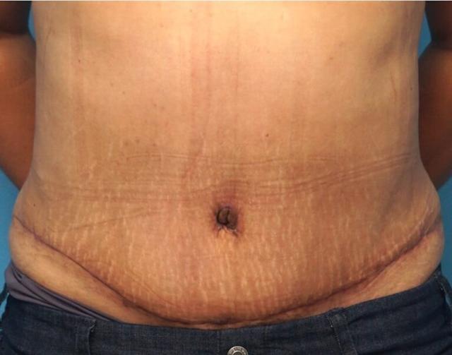 Tummy Tuck after at Seth Plastic Surgery in Northbrook, IL