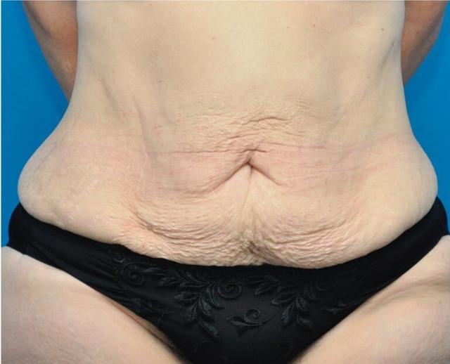 Tummy Tuck before at Seth Plastic Surgery in Northbrook, IL