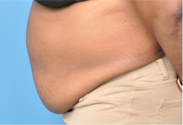 Tummy Tuck before at Seth Plastic Surgery in Northbrook, IL