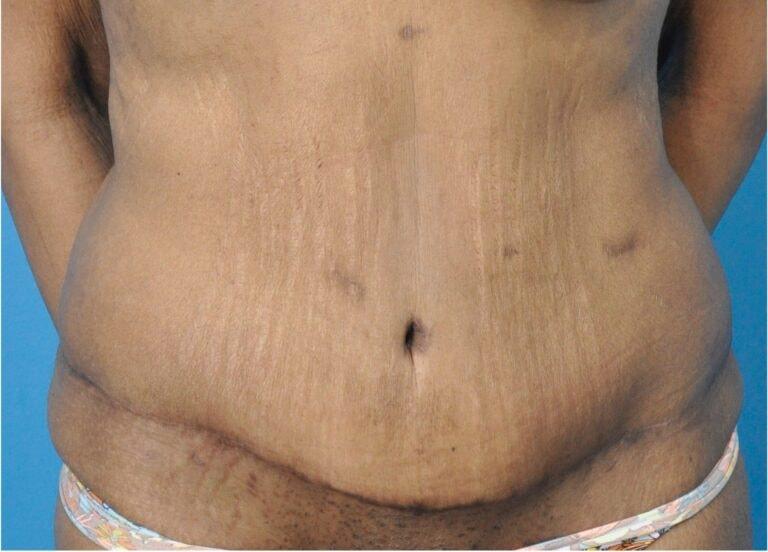 Seth Plastic Surgery tummy tuck after — Northbrook, IL