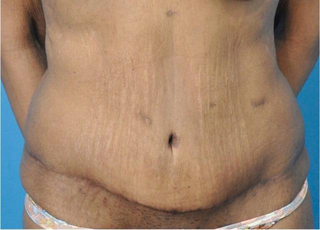 Tummy Tuck after at Seth Plastic Surgery in Northbrook, IL