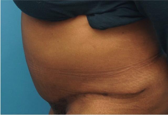 Tummy Tuck after at Seth Plastic Surgery in Northbrook, IL
