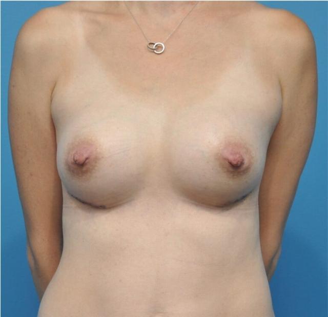 Breast Augmentation after at Seth Plastic Surgery in Northbrook, IL