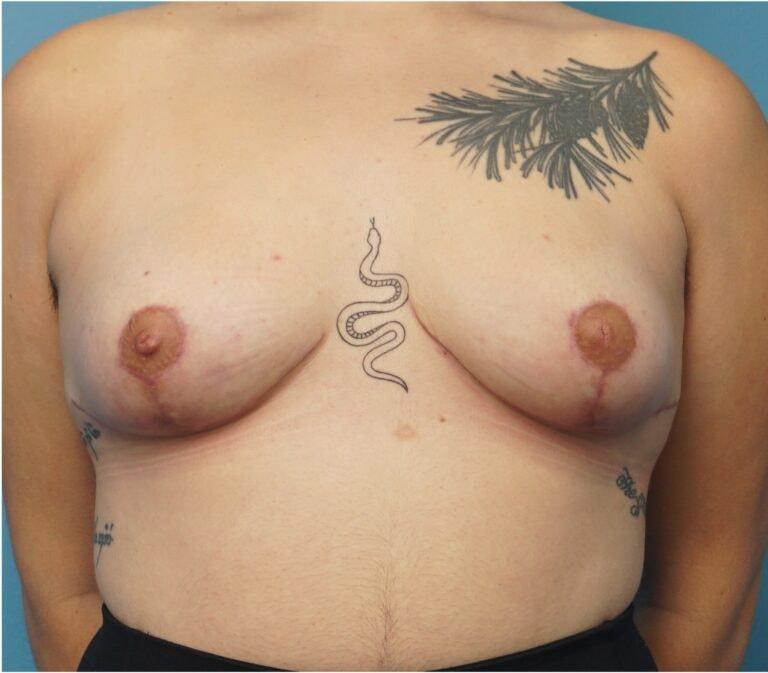 Seth Plastic Surgery breast lift after — Northbrook, IL