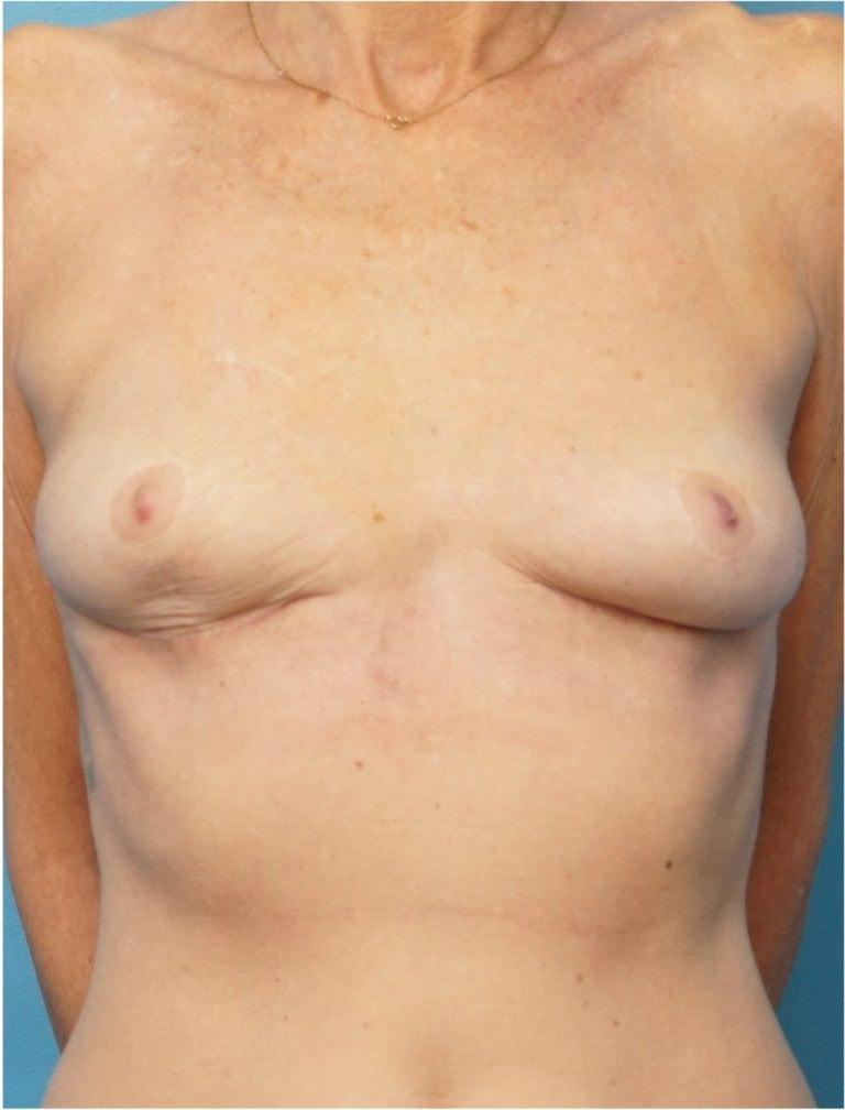 Seth Plastic Surgery breast lift after — Northbrook, IL