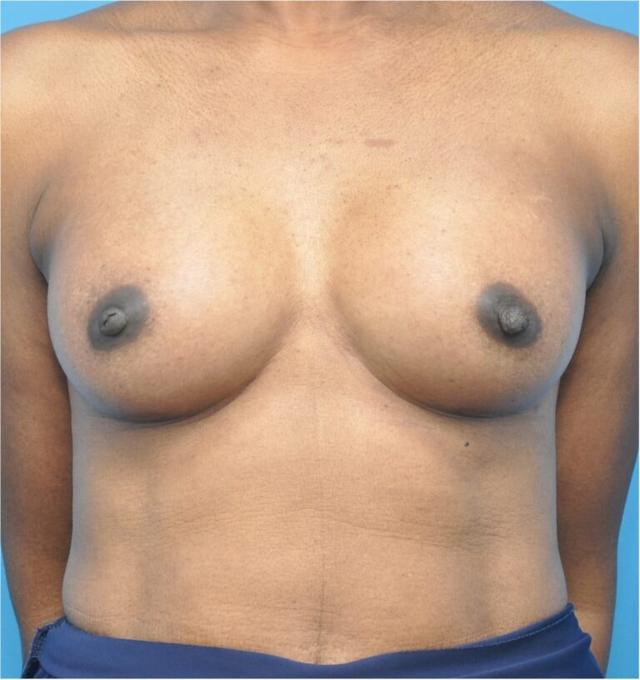 Breast Augmentation after at Seth Plastic Surgery in Northbrook, IL