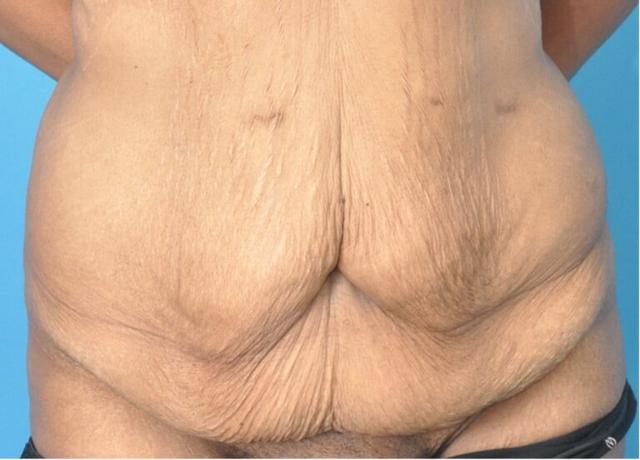 Tummy Tuck before at Seth Plastic Surgery in Northbrook, IL