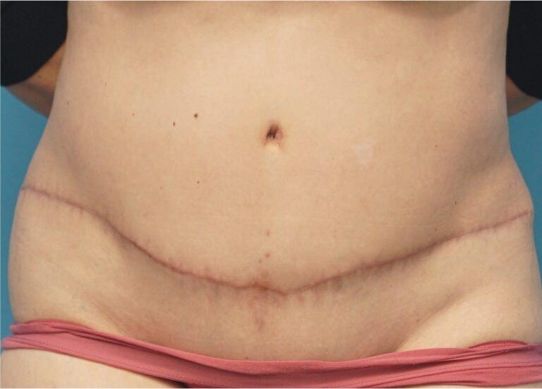 Seth Plastic Surgery tummy tuck after — Northbrook, IL