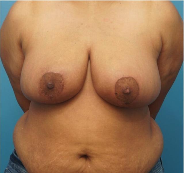 Breast Reduction after at Seth Plastic Surgery in Northbrook, IL