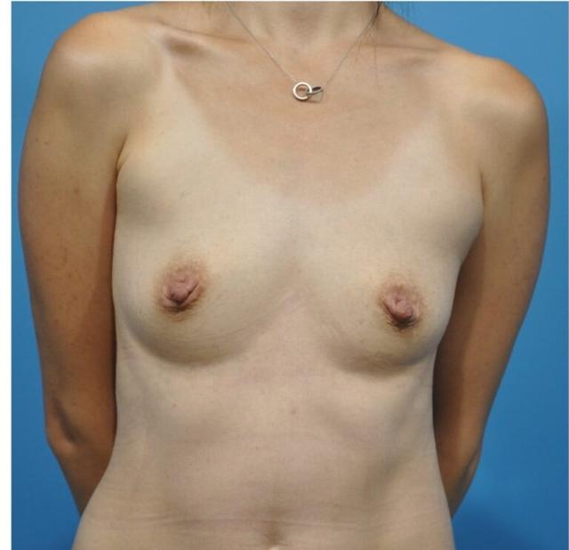 Breast Augmentation before at Seth Plastic Surgery in Northbrook, IL