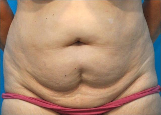 Tummy Tuck before at Seth Plastic Surgery in Northbrook, IL