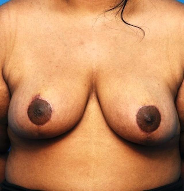 Breast Reduction after at Seth Plastic Surgery in Northbrook, IL
