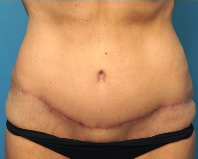 Tummy Tuck after at Seth Plastic Surgery in Northbrook, IL