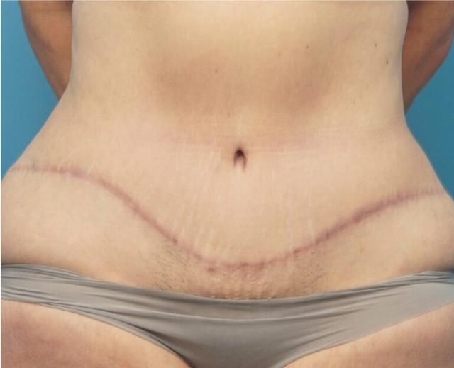 Tummy Tuck after at Seth Plastic Surgery in Northbrook, IL
