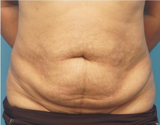 Tummy Tuck before at Seth Plastic Surgery in Northbrook, IL