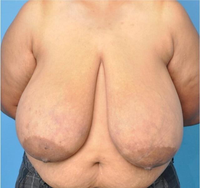 Breast Reduction before at Seth Plastic Surgery in Northbrook, IL