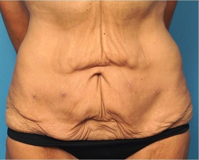 Tummy Tuck before at Seth Plastic Surgery in Northbrook, IL