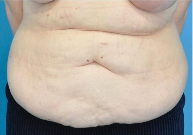 Tummy Tuck before at Seth Plastic Surgery in Northbrook, IL