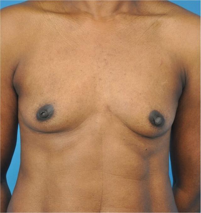 Breast Augmentation before at Seth Plastic Surgery in Northbrook, IL