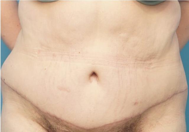 Tummy Tuck after at Seth Plastic Surgery in Northbrook, IL