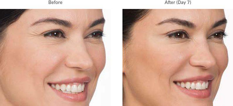 LVS La Vie Med Spas + Day Spa botox result — Austin, TX