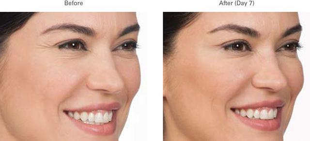 Botox result at LVS La Vie Med Spas + Day Spa in Austin, TX