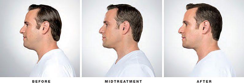 LVS La Vie Med Spas + Day Spa botox result — Austin, TX