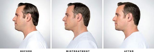 Botox result at LVS La Vie Med Spas + Day Spa in Austin, TX