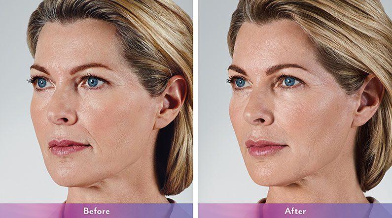 LVS La Vie Med Spas + Day Spa facelift result — Austin, TX