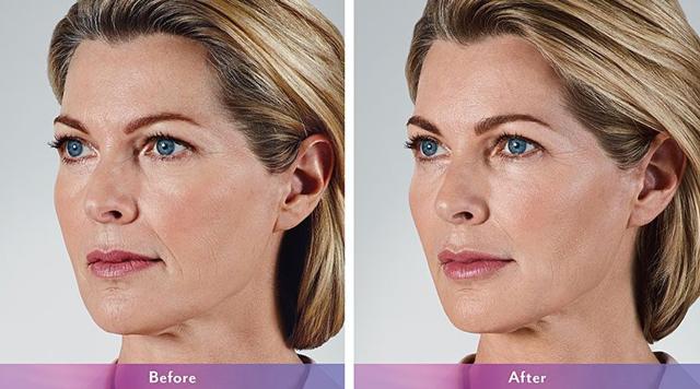Facelift result at LVS La Vie Med Spas + Day Spa in Austin, TX