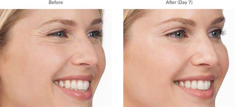 LVS La Vie Med Spas + Day Spa botox result — Austin, TX