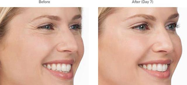 Botox result at LVS La Vie Med Spas + Day Spa in Austin, TX
