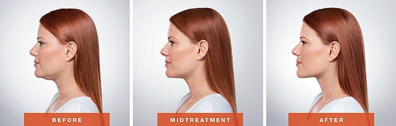 LVS La Vie Med Spas + Day Spa botox result — Austin, TX