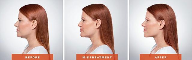 Botox result at LVS La Vie Med Spas + Day Spa in Austin, TX