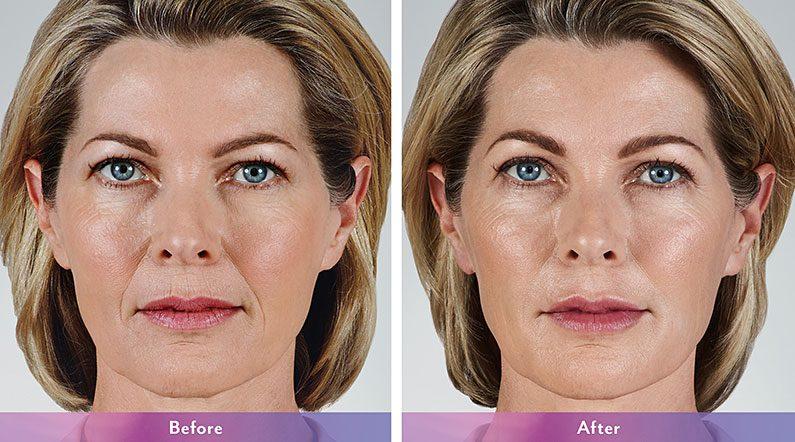 LVS La Vie Med Spas + Day Spa facelift result — Austin, TX