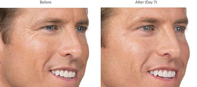 Botox result at LVS La Vie Med Spas + Day Spa in Austin, TX