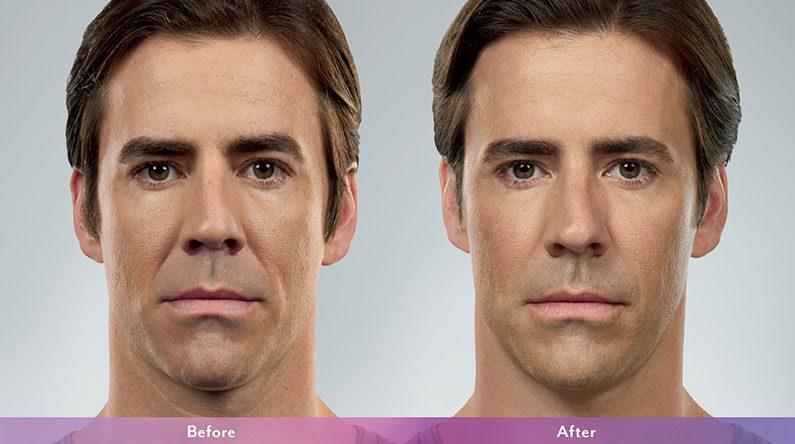 LVS La Vie Med Spas + Day Spa facelift result — Austin, TX