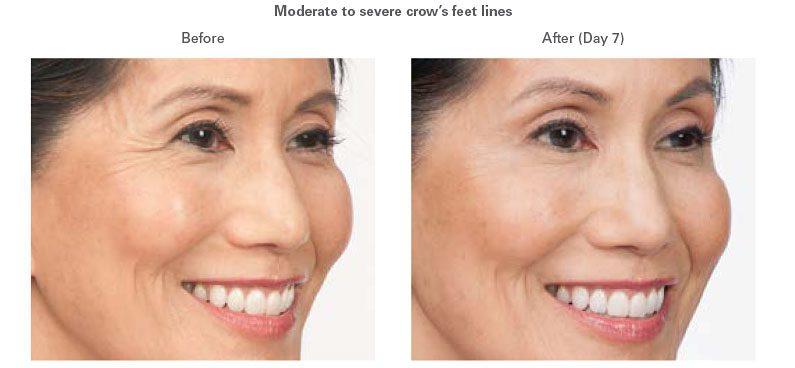 LVS La Vie Med Spas + Day Spa botox result — Austin, TX