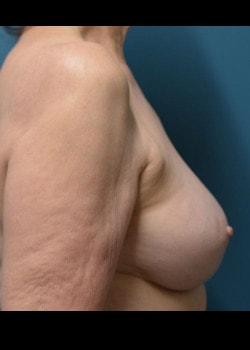 Breast Reduction after at Jessica Belz, MD in San Antonio, TX