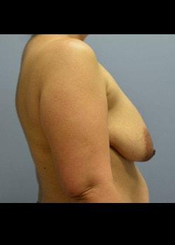 Breast Lift before at Jessica Belz, MD in San Antonio, TX