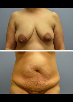 Mommy Makeover before at Jessica Belz, MD in San Antonio, TX
