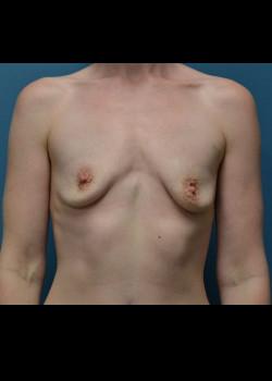 Breast Augmentation before at Jessica Belz, MD in San Antonio, TX
