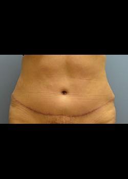 Jessica Belz, MD after — San Antonio, TX