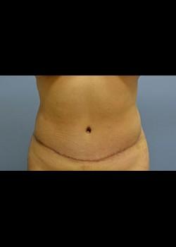 Jessica Belz, MD tummy tuck after — San Antonio, TX