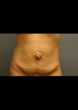 Mini Tummy Tuck before at Jessica Belz, MD in San Antonio, TX