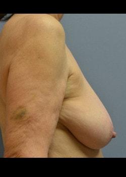 Breast Reduction before at Jessica Belz, MD in San Antonio, TX