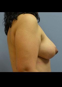 Breast Lift after at Jessica Belz, MD in San Antonio, TX