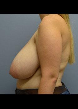 Breast Reduction before at Jessica Belz, MD in San Antonio, TX